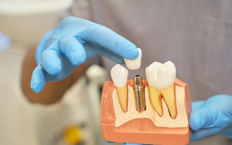 benefits of dental implant 