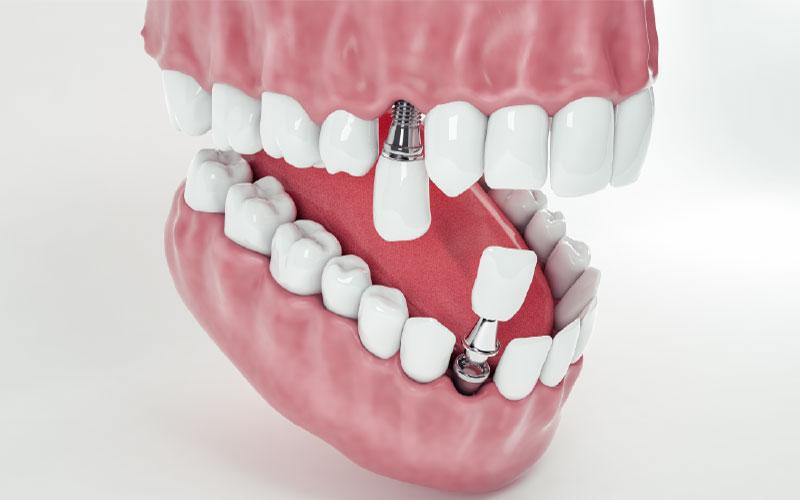 dental implant services in Simi Valley