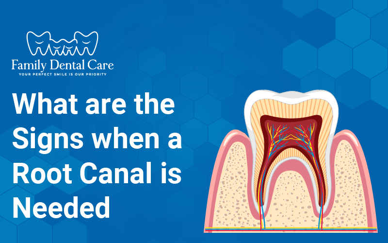 What Are the Signs A Root Canal is Needed ?