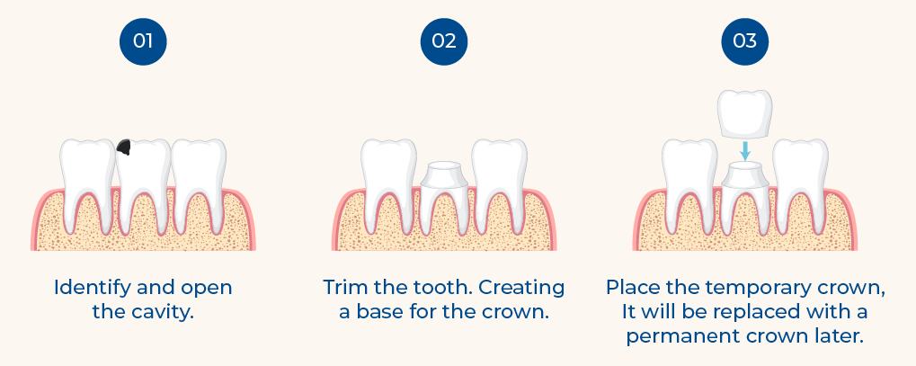 Dental Crown Procedure