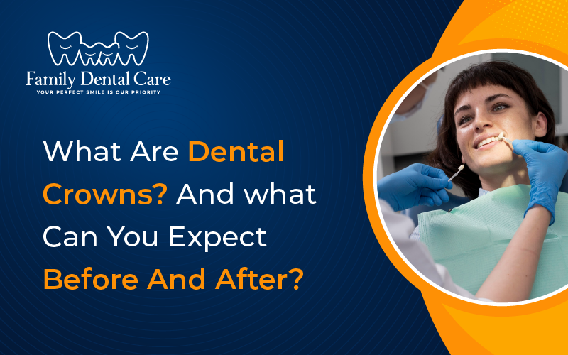 What Are Dental Crowns And what Can You Expect Before And After