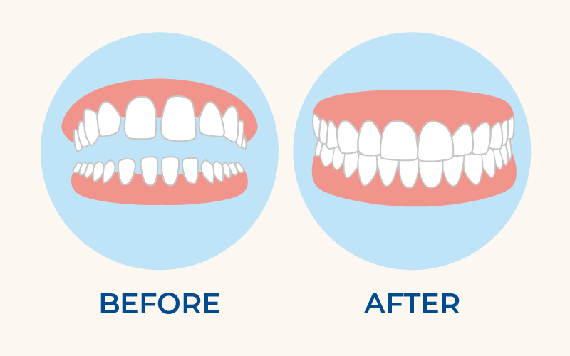 What To Expect Before And After The Tooth Crown Treatment